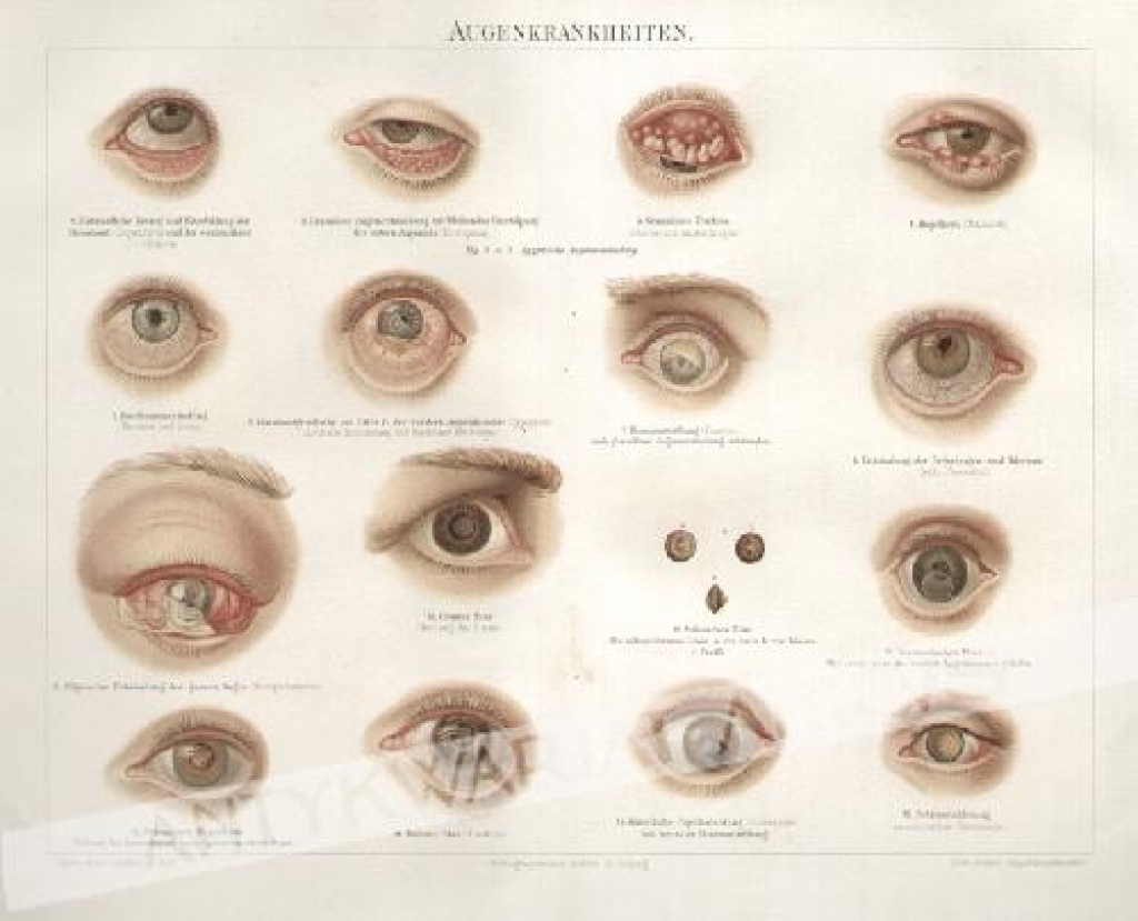 [rycina, 1893] Augenkrankheiten [choroby oczu]